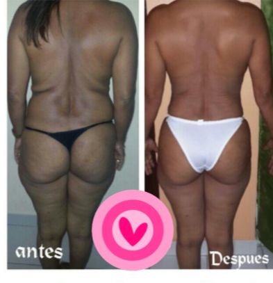Resultado de tratamiento estético 1
